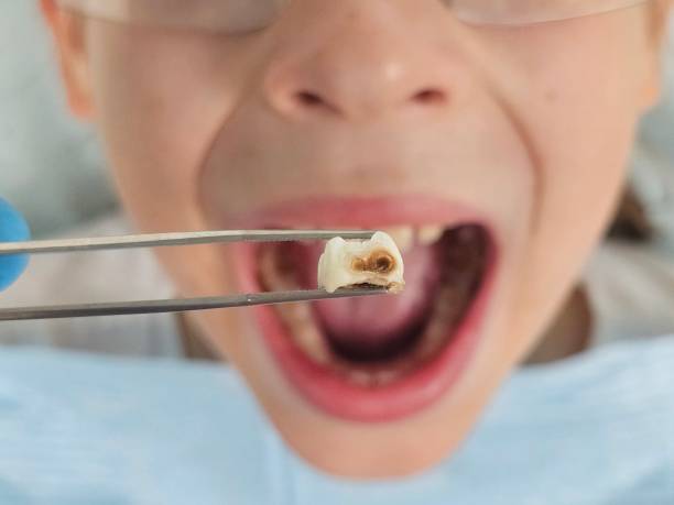 Best Emergency Tooth Extraction in Kernersville, NC